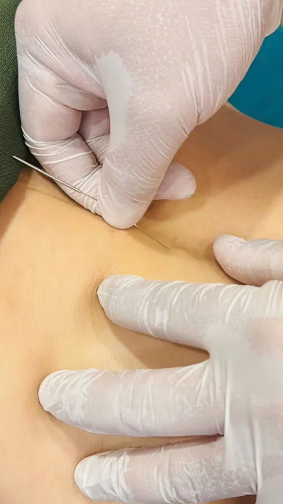 Châm cứu trị đau tức ngực