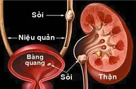 Hình ảnh sỏi thận